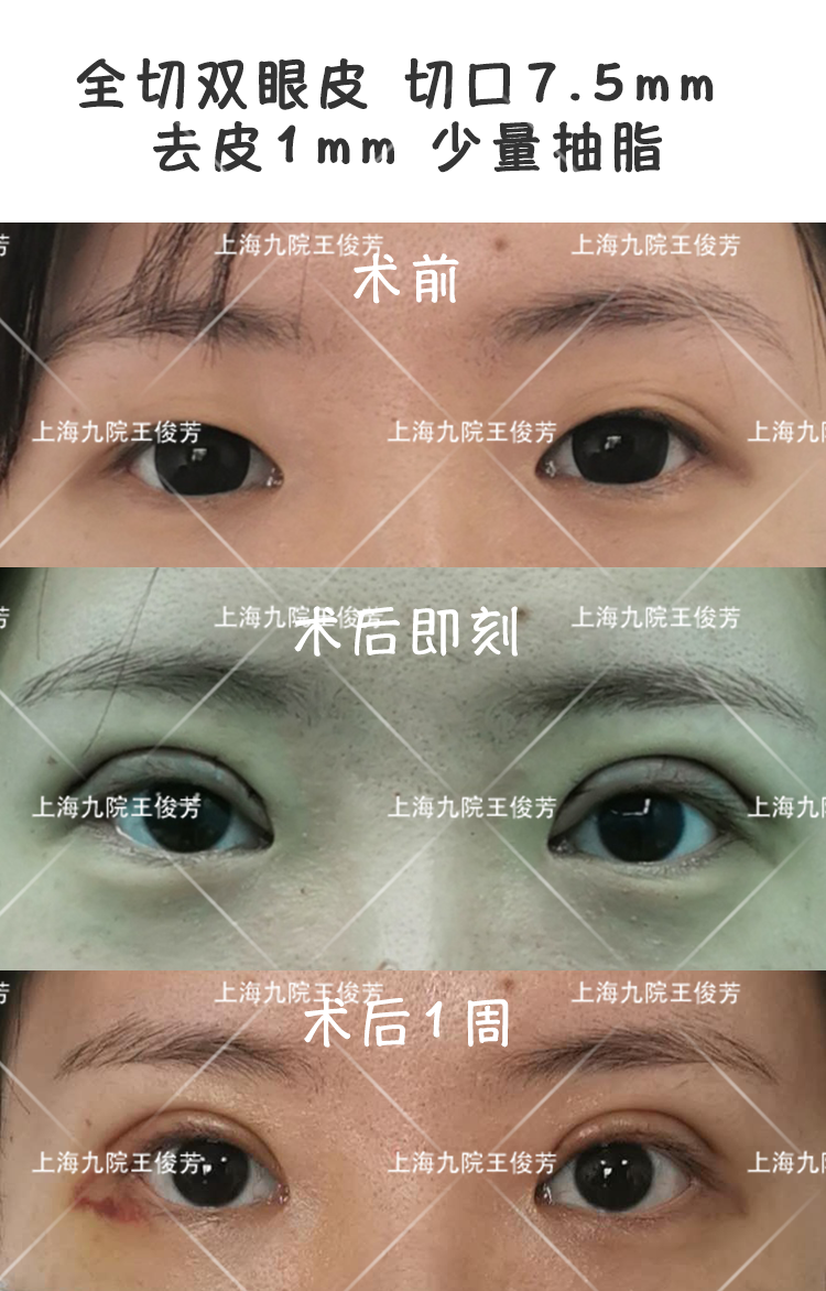 5mm双眼皮恢复后图,5mm双眼皮一年后图片 【全切双眼皮(切口7.5mm )去皮1mm 少量抽脂】案例分享