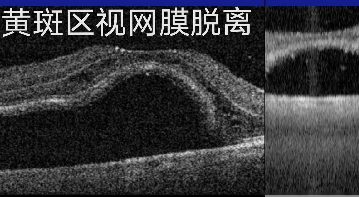 下面两图分别为孔源性视网膜脱离的眼底照相及黄斑oct检查报告.3.