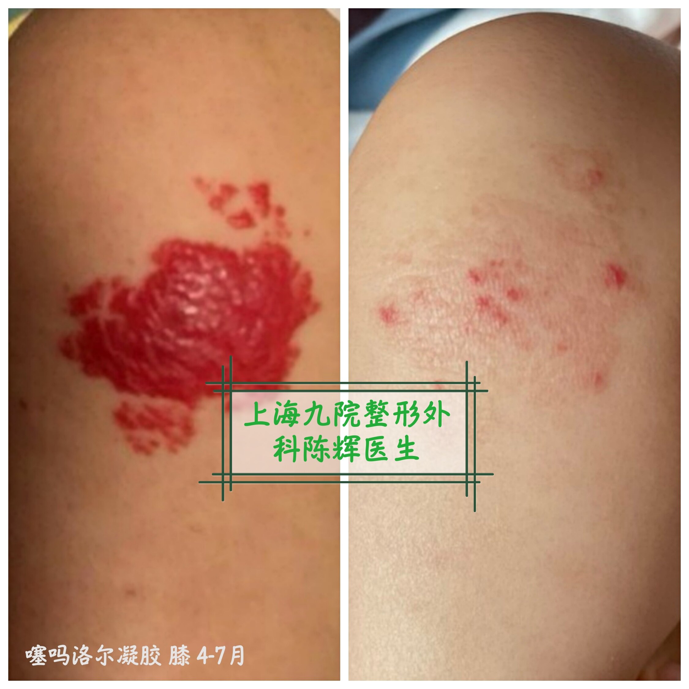 噻吗洛尔凝胶治疗婴幼儿血管瘤的使用方法和注意事项