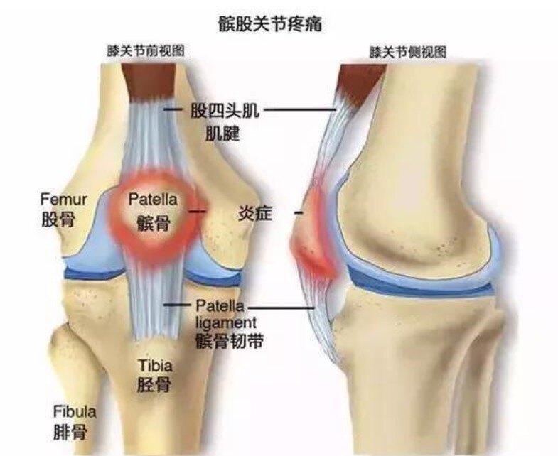 膝盖过度活动者:人体上下楼梯以及登山时,髌骨需要承受3倍体重;而在