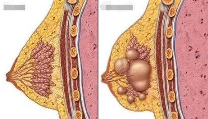 曾立谈隆胸有乳腺结节做了假体隆胸会癌变吗