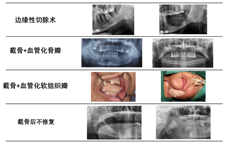 放疗后颌面部骨坏死