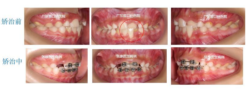 个别前牙反牙合早期矫正一例