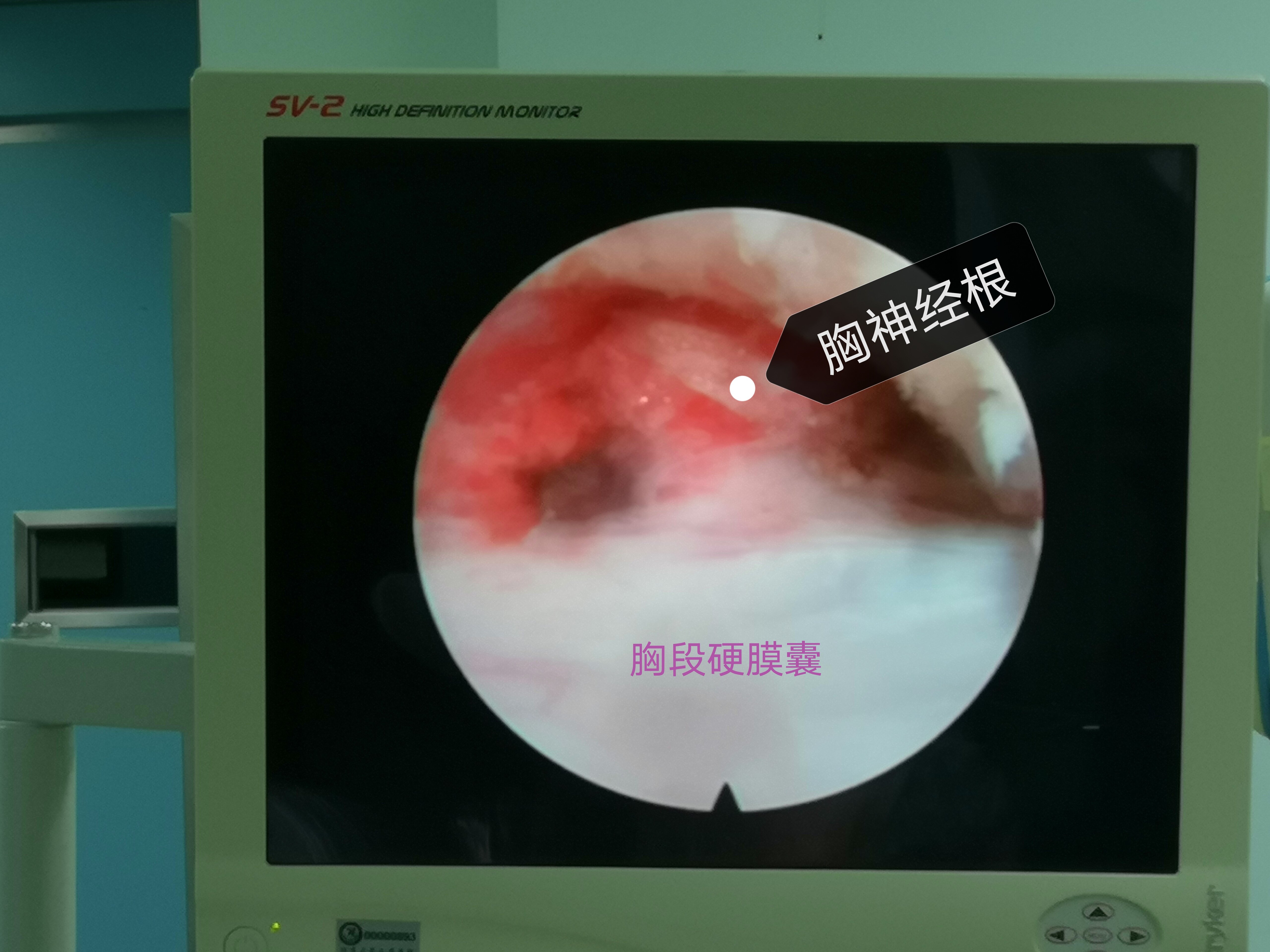 硬膜囊及神经根充分减压.