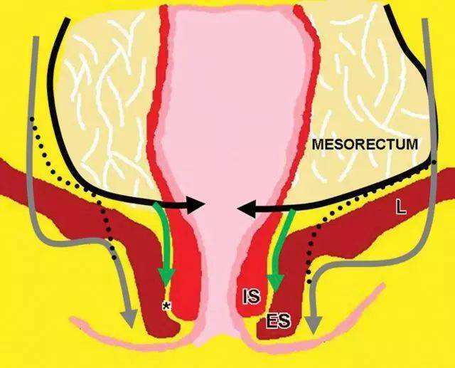 距离肛门25㎝辗转多地无法保肛患者拒绝手术最后我们团队成功保肛