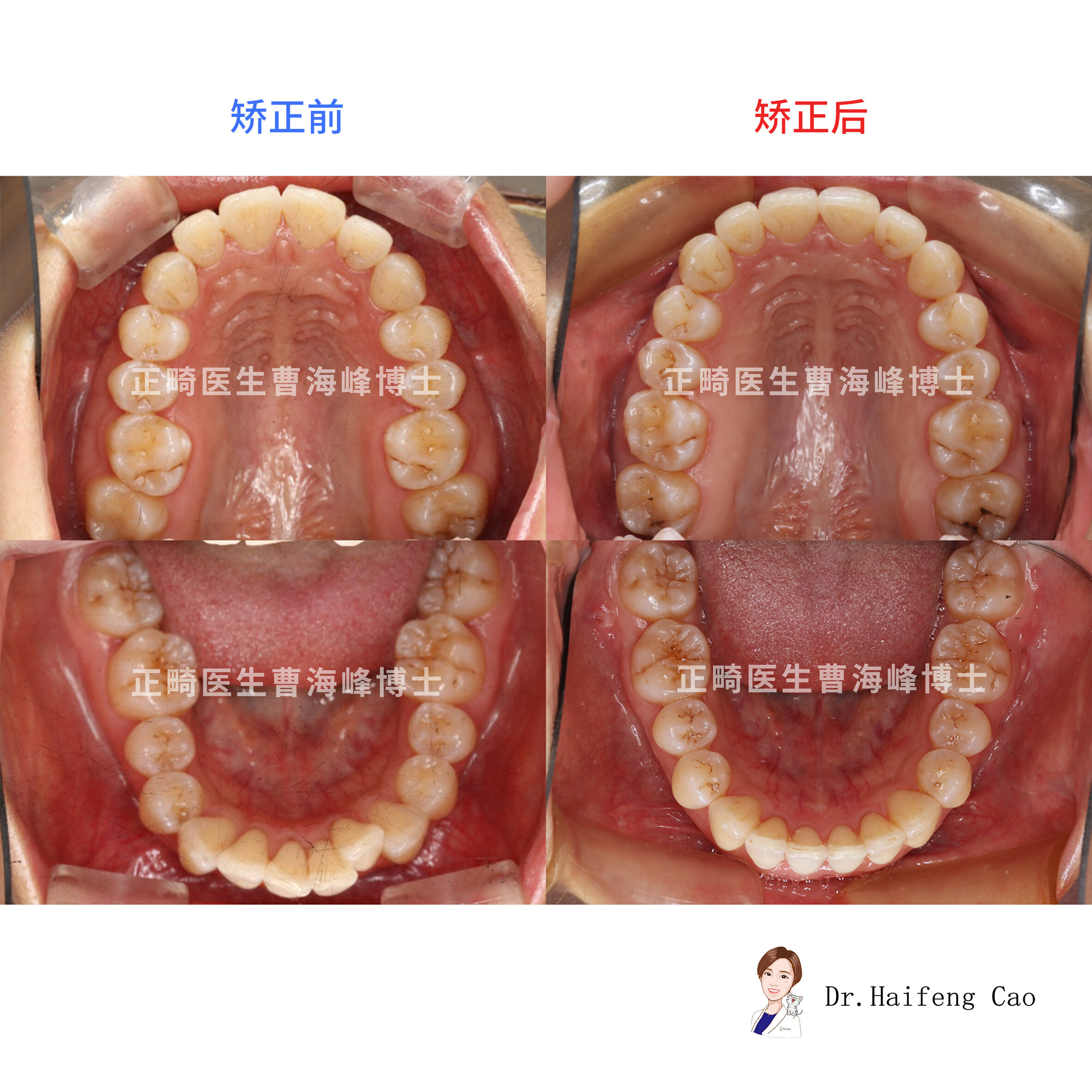 牙槽骨薄型隐形矫正案例