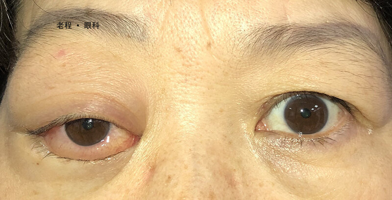 眼眶恶性 淋巴瘤 造成的眼球突出