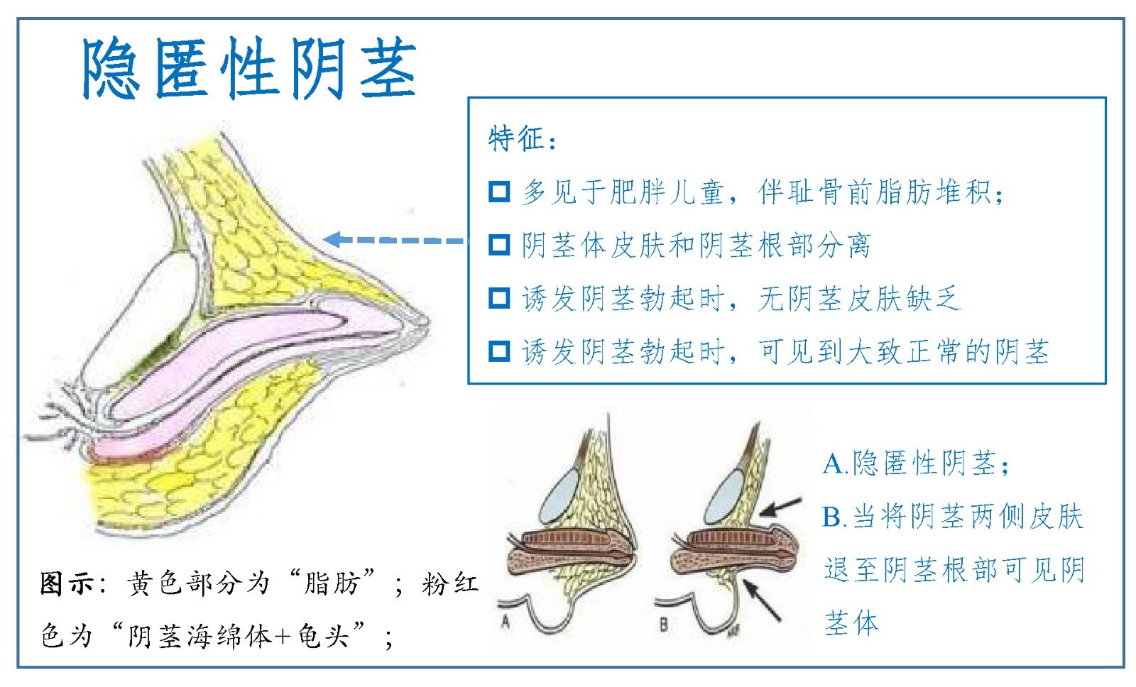 带你认识一个疾病「隐匿性阴茎」让男孩阴茎短小,需要手术整形