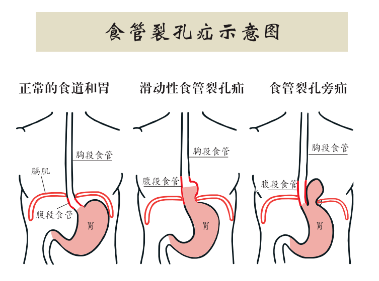 食管裂孔疝是什么病应该如何治疗医生详解治疗方案