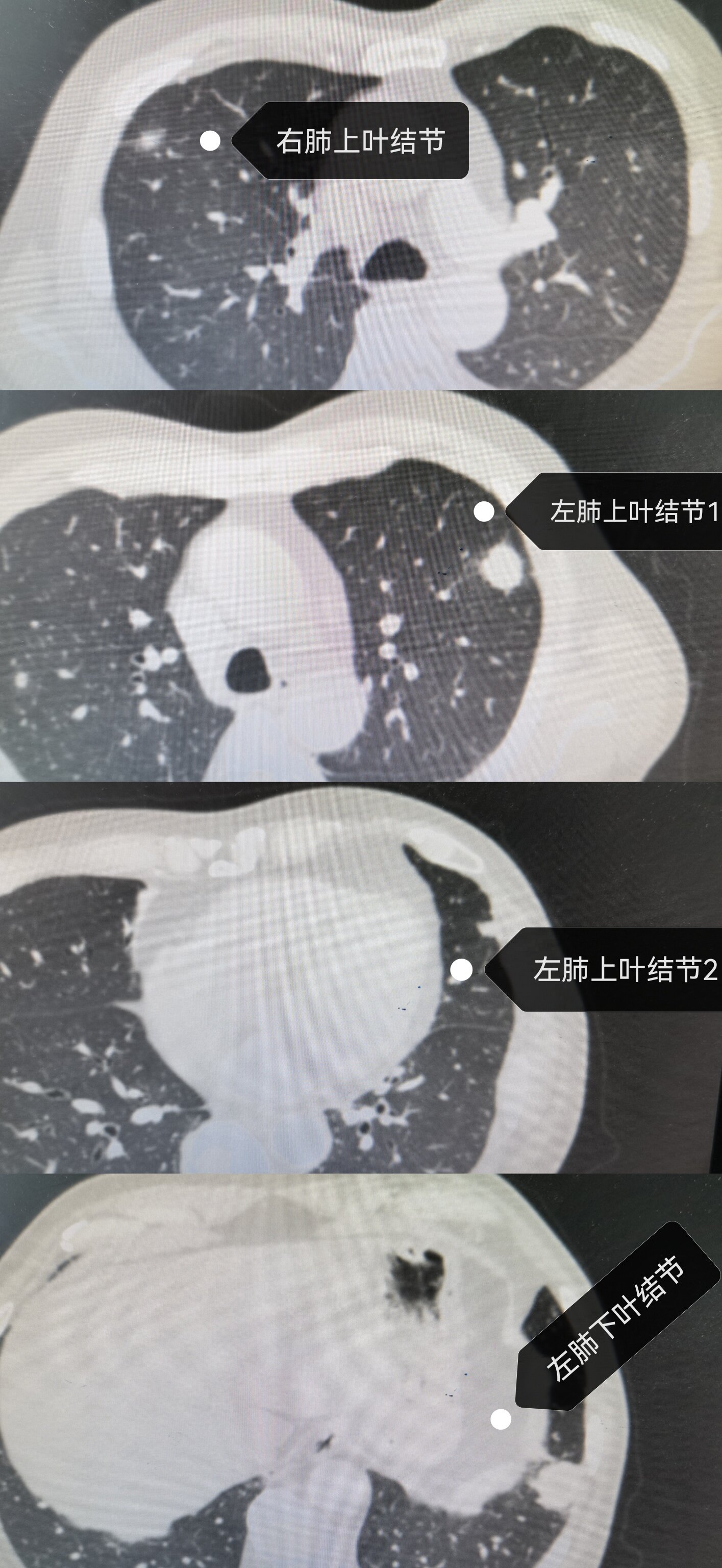 多发肺结节病变单孔胸腔镜uvats一次全部切除