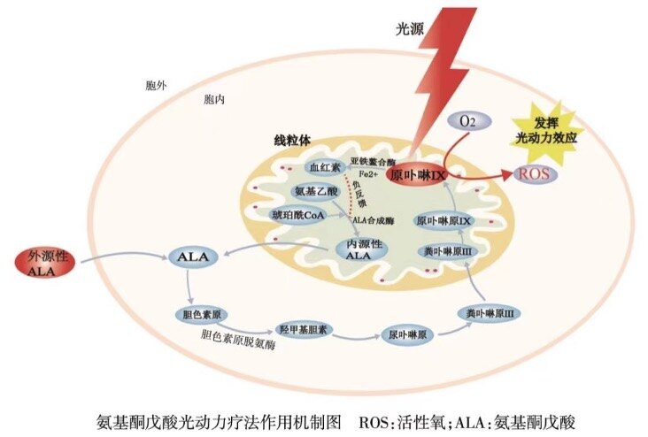 光动力治疗疾病机理