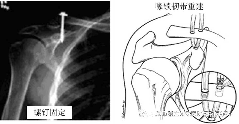 肩锁关节损伤与疼痛下