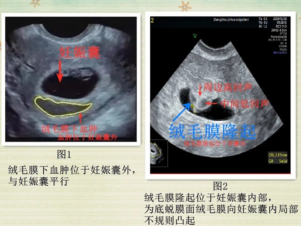 神秘的绒毛膜隆起虽凶险仍可医