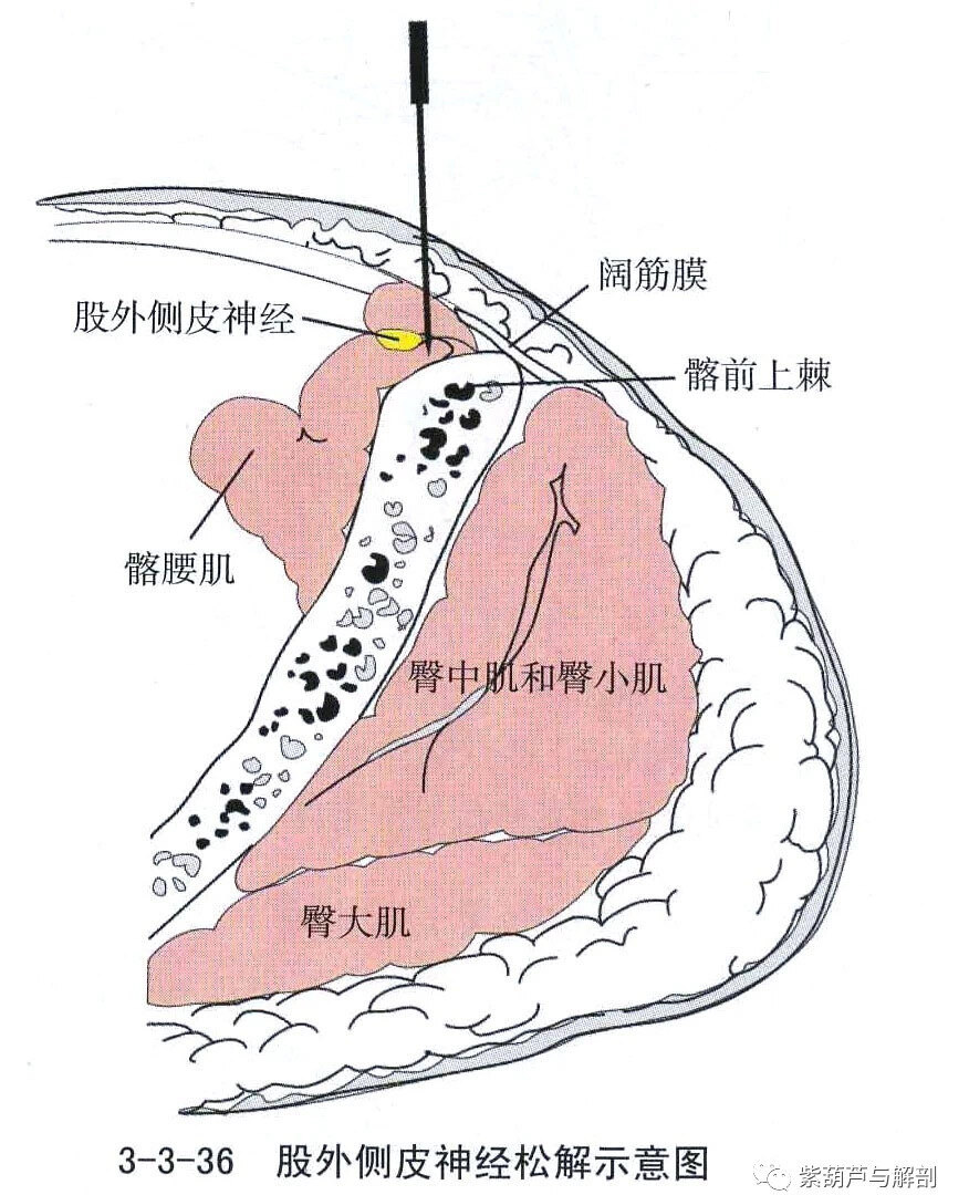 小针刀松解路径与股外侧皮神经阻滞路径大致相同