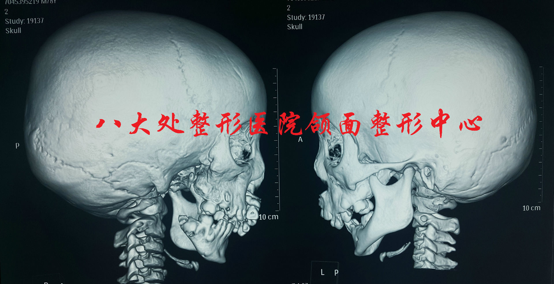 半侧颜面短小畸形,又称第一二腮弓综合征,是一种常见的先天性颅颌面