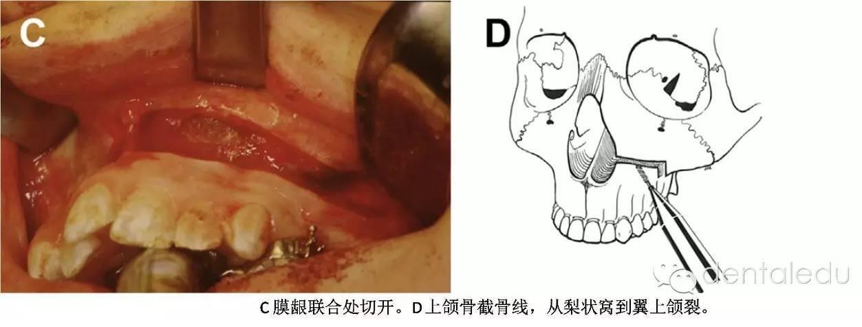 2:1(三)手术步骤:常规的le fort i型骨切开术 腭中缝骨切开术.