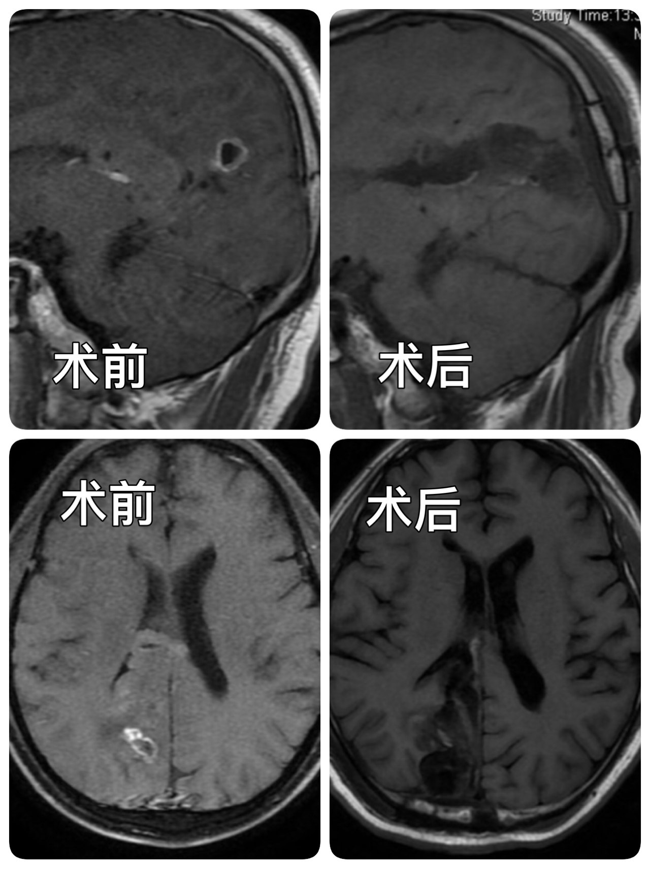 微创锁孔切除胼胝体压部肿瘤窦以河青大附院