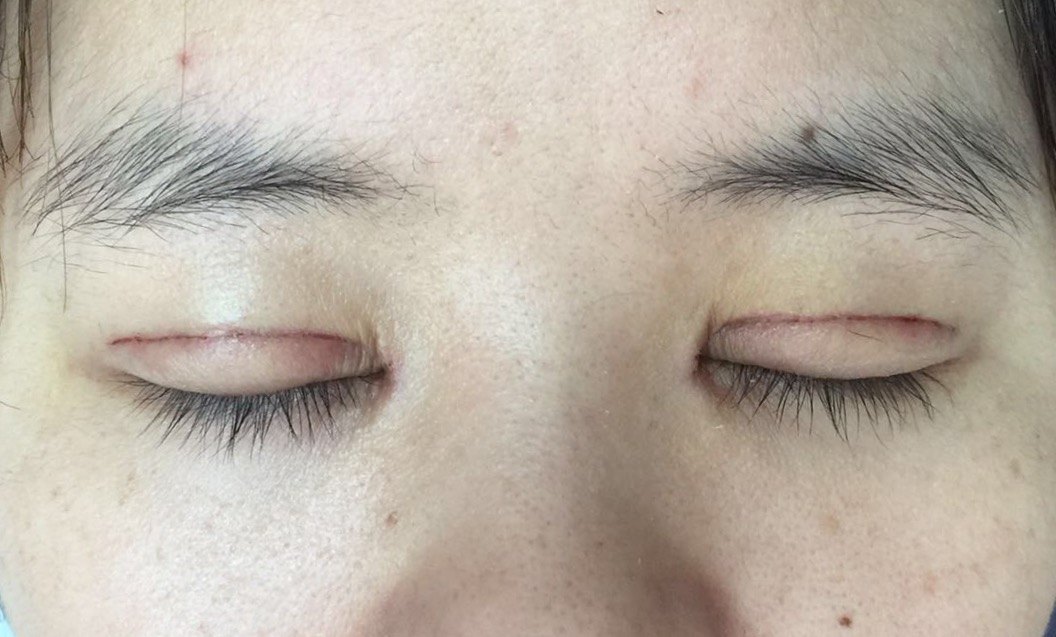 双眼皮切开术后动态恢复过程