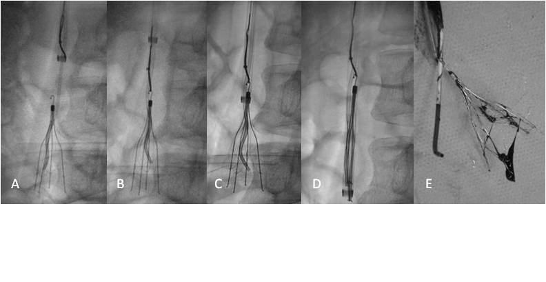 疑难性下腔静脉滤器取出的技巧及策略 - 好大夫