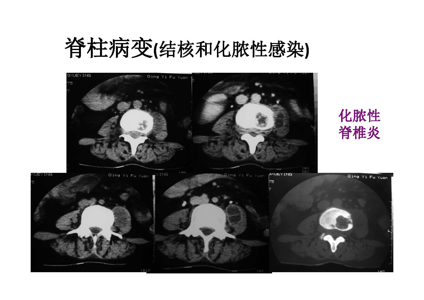 脊柱病理性病变的影像学