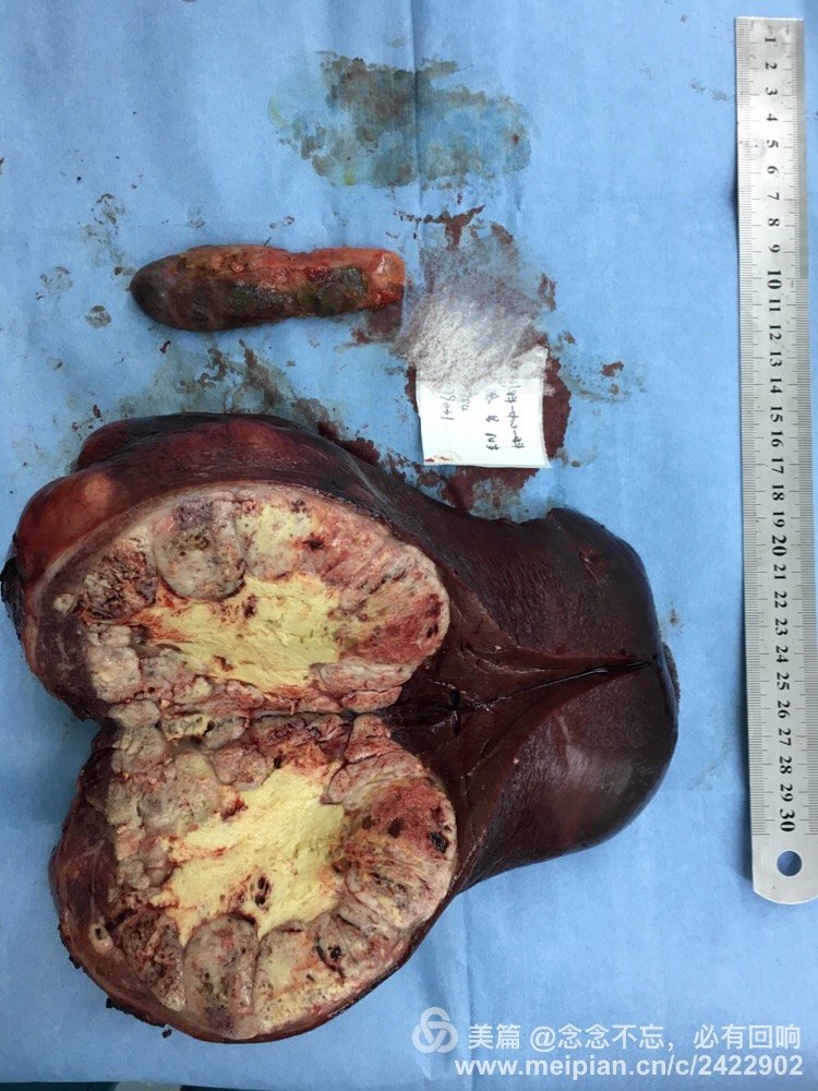 巨大肝癌能手术吗?