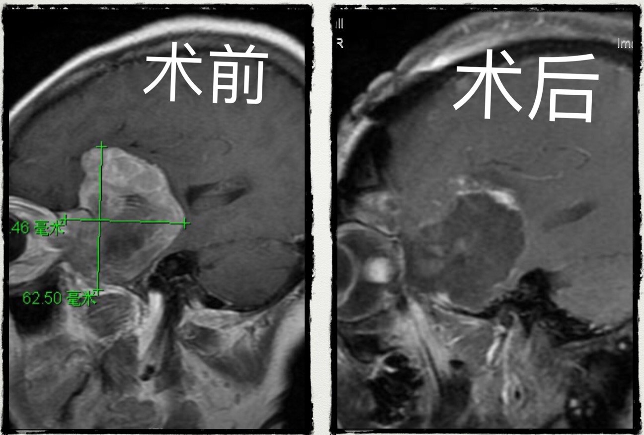 显微手术切除巨大蝶骨嵴内侧脑膜瘤窦以河青大附院