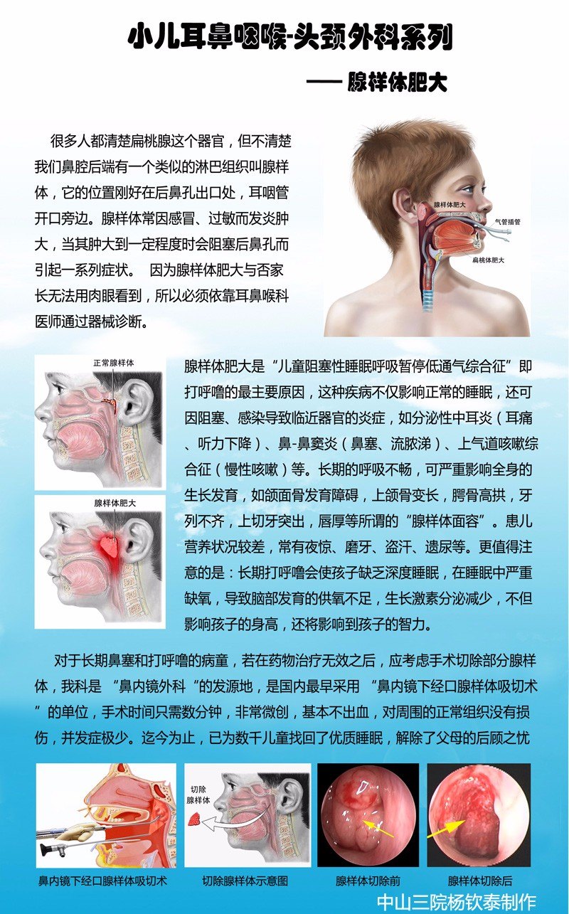 我怎么治疗腺样体肥大?