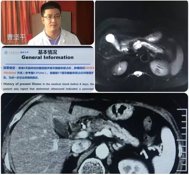 (四,普外四科侍力刚医师《胰腺囊性占位一例》