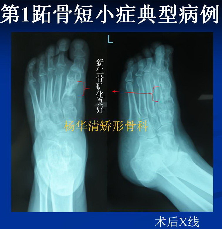 杨华清第一跖骨短小症的治疗