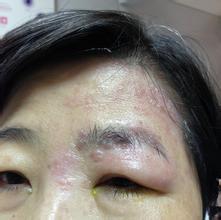 眼睑带状疱疹及引起的病毒性角膜炎的经验治疗