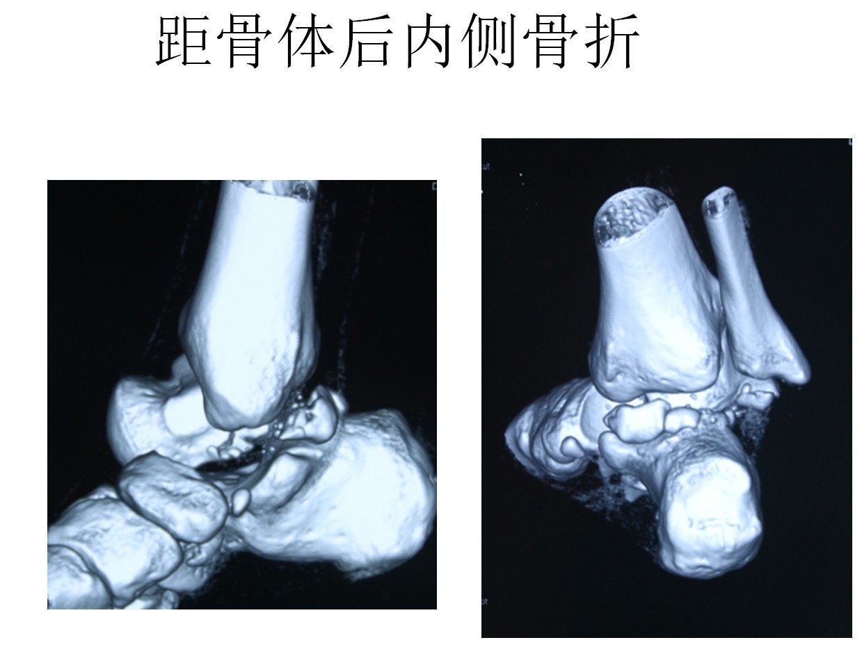 距骨骨折的踝关节镜下复位内固定治疗(病例2)