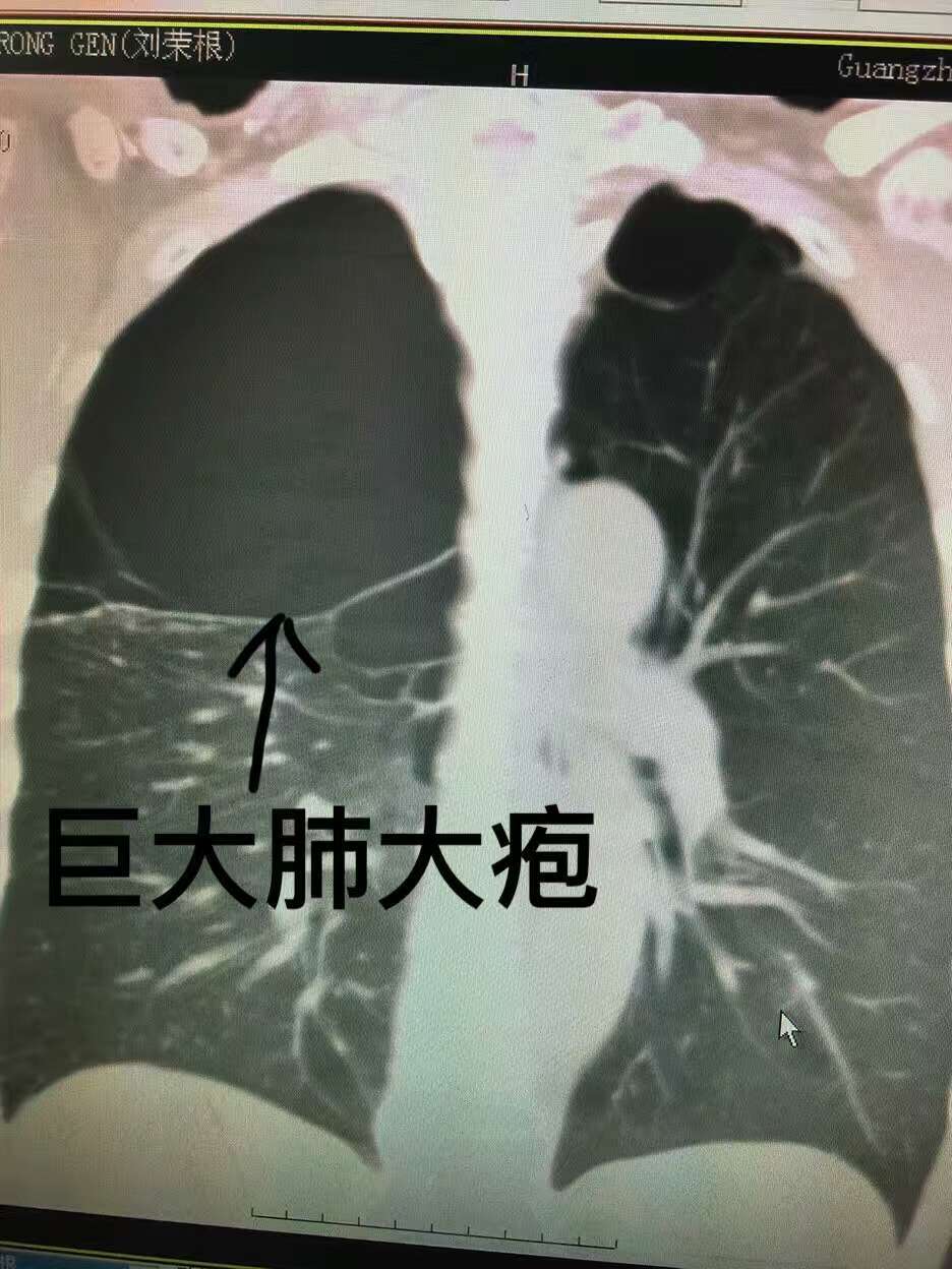 吸烟四十多年,肺气肿,肺大疱,肺如黑炭!您还敢吸烟吗?