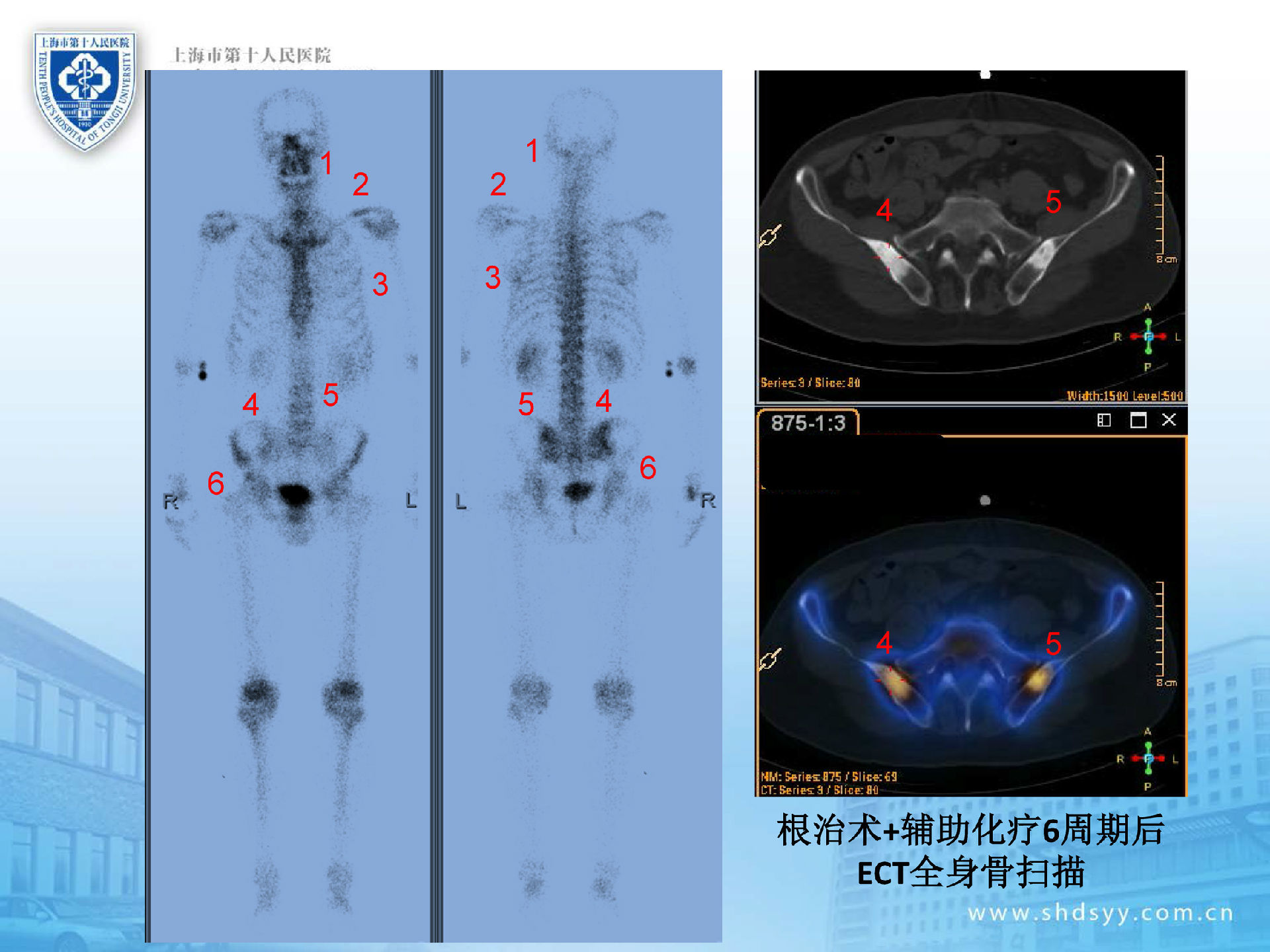 根治术 辅助化疗6周期后ect全身骨扫描