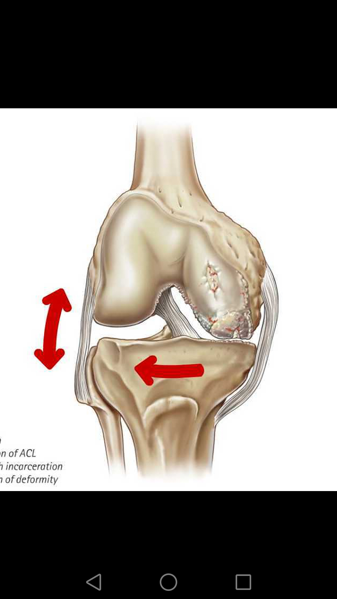膝关节骨性关节炎的梯度治疗