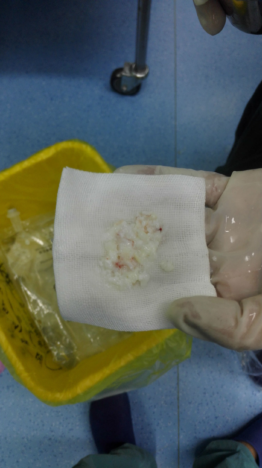 椎间孔镜技术治疗腰椎间盘突出伴广泛钙化 - 好