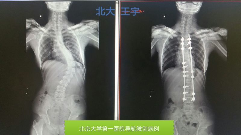 宾川12岁贫困少女脊柱侧弯爱心为她撑起一片天