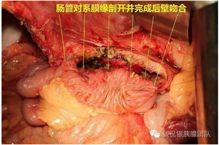 胰管结石,慢性胰腺炎的引流手术