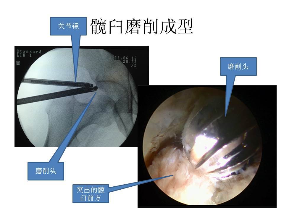原创 揭秘髋关节镜手术,一起来涨姿势!