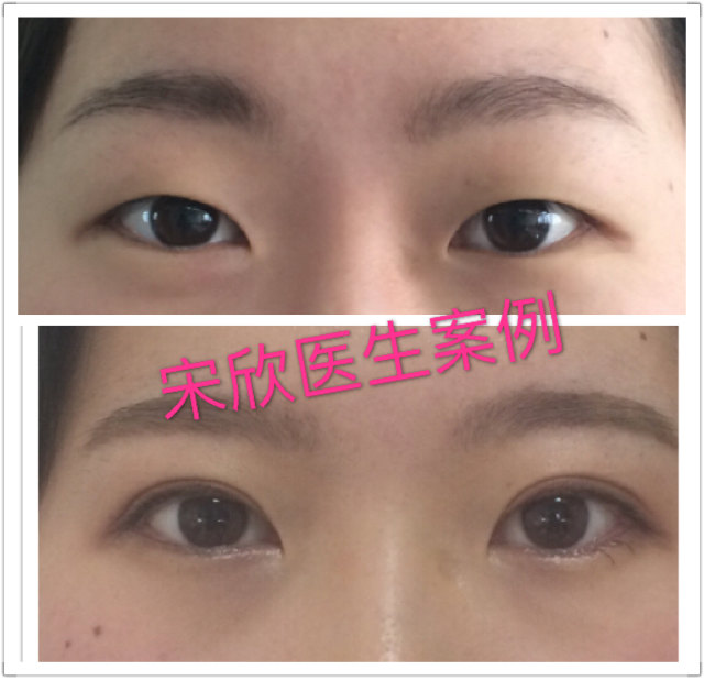 双眼皮,开眼角,上睑下垂手术前后对比