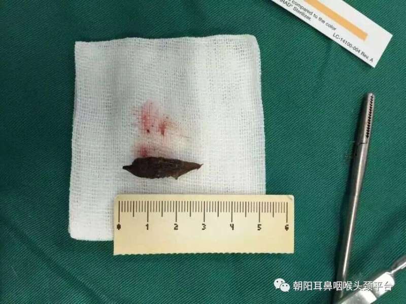 食道异物～枣核