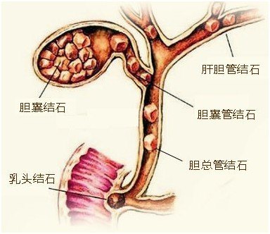 诱因有多种,胆管本身的炎症,狭窄,胆汁成分的变化及胆肠循环的异常