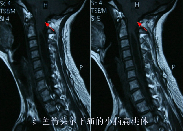 浅谈--小脑扁桃体下疝畸形