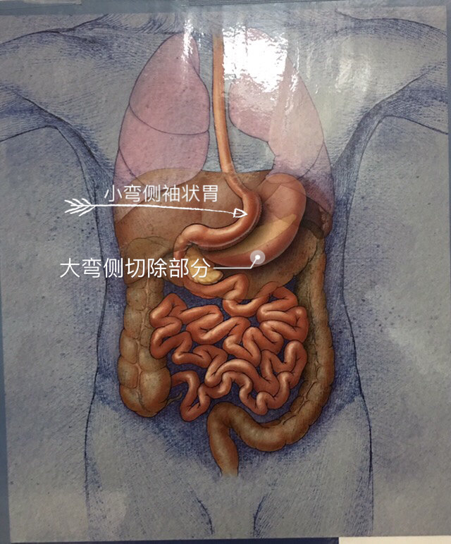 袖状胃切除术减肥手术介绍(之二)_肥胖症_疾病