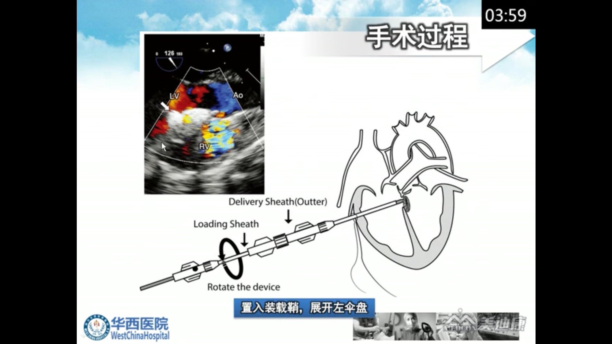室间隔缺损封堵示意图