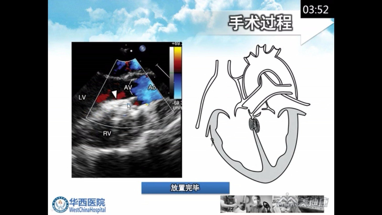 室间隔缺损封堵示意图