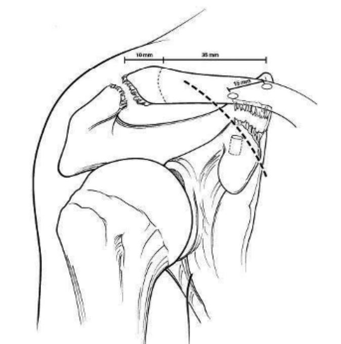 上图:重建喙锁韧带方法之一.
