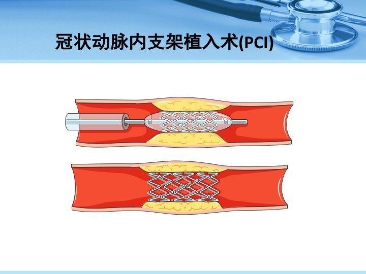 冠脉支架与搭桥手术哪个好