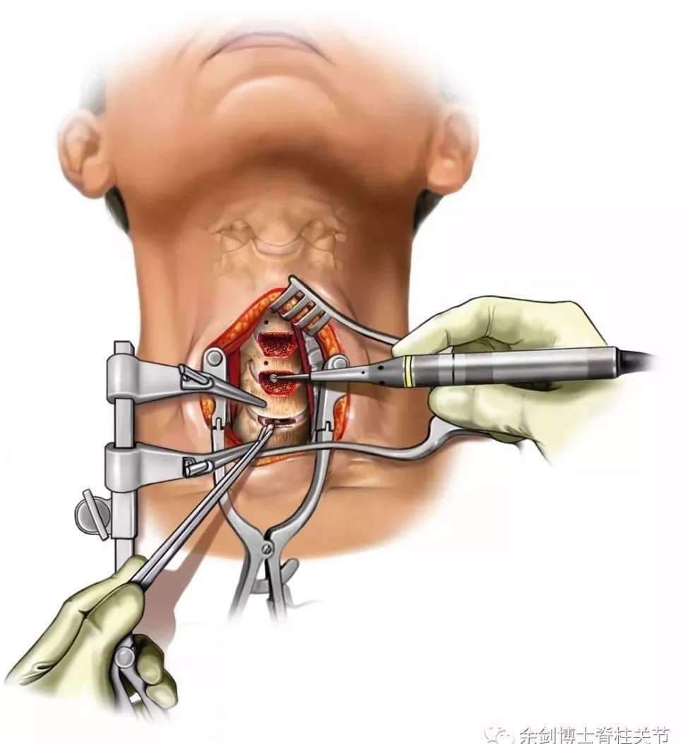 【领先技术】颈椎病的手术治疗(1):颈前路减压 零切迹