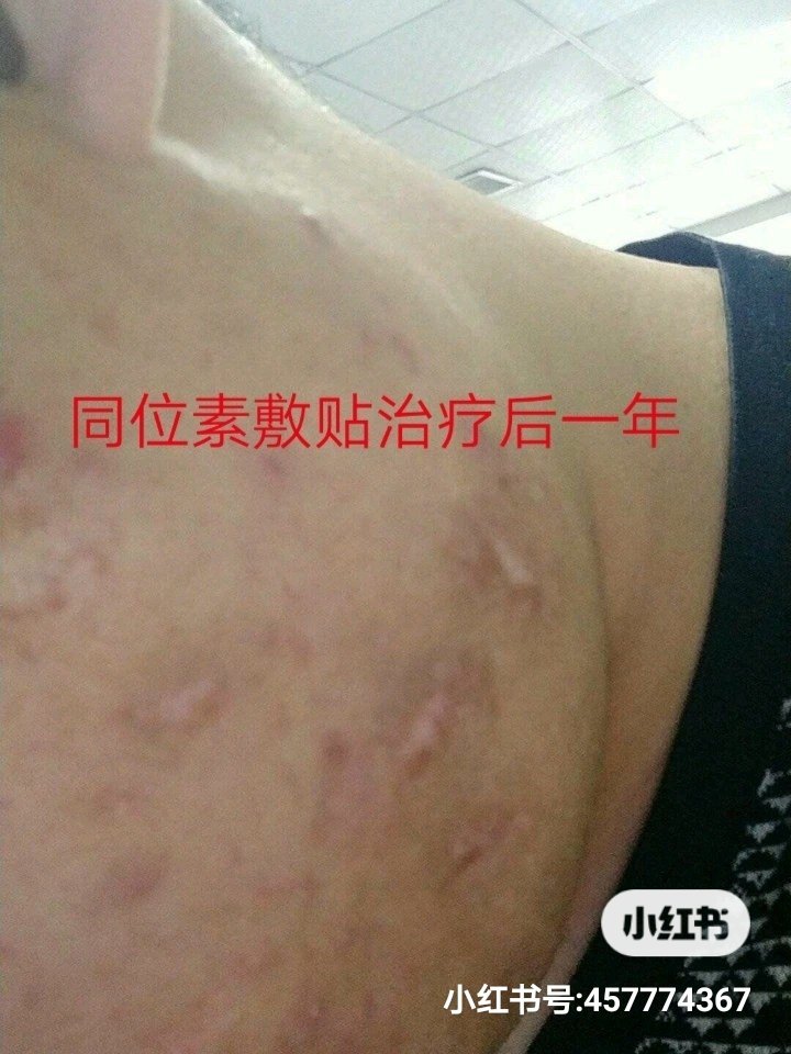 面部疤痕疙瘩同位素敷贴治疗后随访