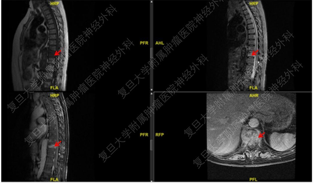 术前胸椎mri